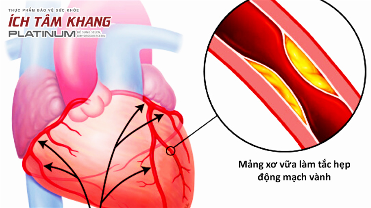 Bệnh động mạch vành là nguyên nhân chủ yếu gây triệu chứng đau tim